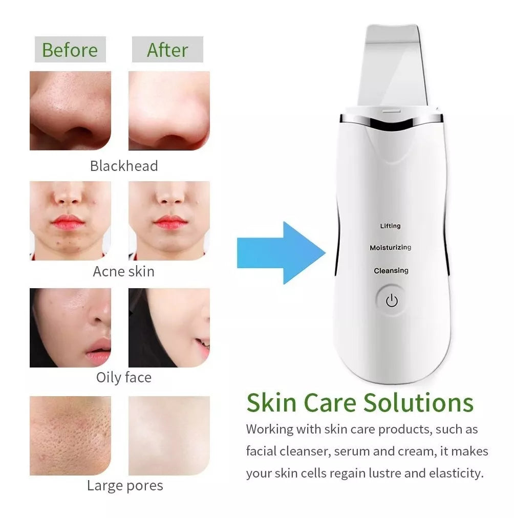 Espátula Facial Ultrasónica ✨ Limpiador Profundo de Piel