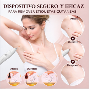 Removedor Cauterizador Quita Verrugas Pecas De Plasma Láser